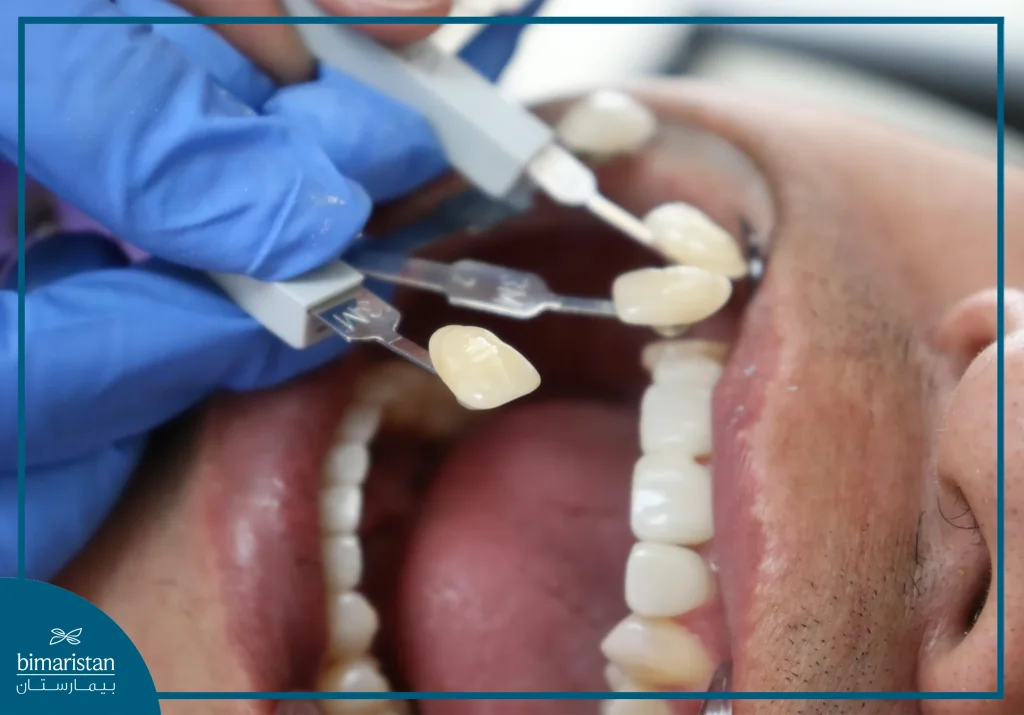 Zirconium Veneers In Turkey: Types, Benefits &Amp; Latest Tech 2 Zirconium Veneers In Turkey