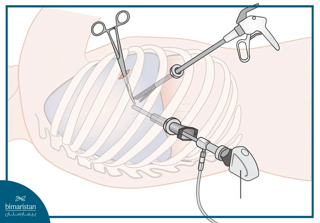 Everything You Need To Know About Video Thoracoscopy 3 Video Thoracoscopy Is Performed Through Three Small Holes In The Patient'S Chest Through Which Surgical Instruments Are Inserted, In Addition To An Endoscope Equipped With A Camera.