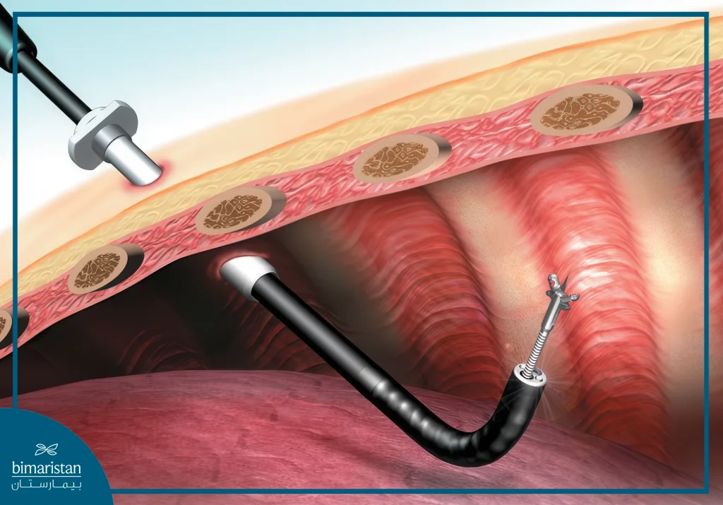 Everything You Need To Know About Video Thoracoscopy 4 Video Thoracoscopy In Turkey Can Be Used To Remove Affected Lymph Nodes.