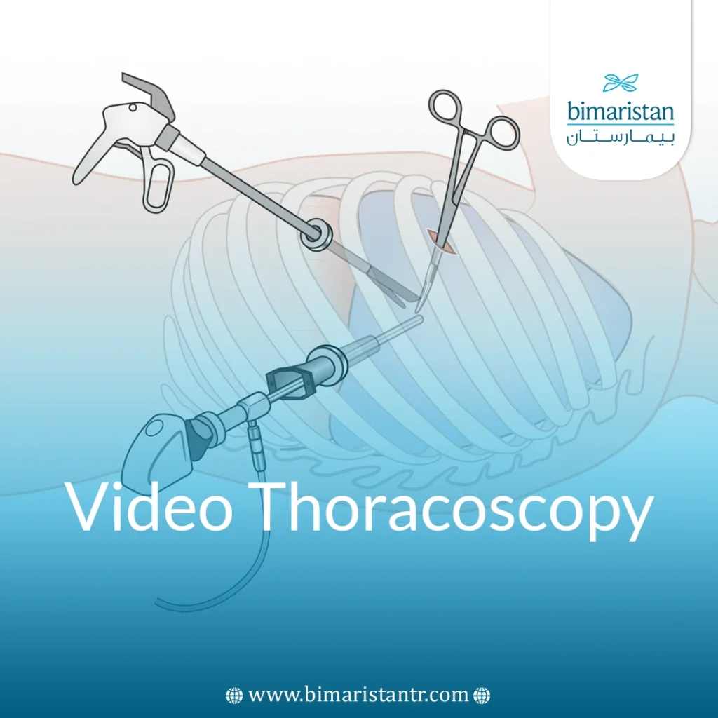 Toracoiscopia Video Thoracoscopy in Turkey: Essential Guide - Bimaristan