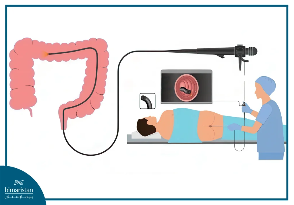 Colonoscopy In Turkey: Procedure, Benefits, And Preparation Guide 4 How To Perform A Colonoscopy