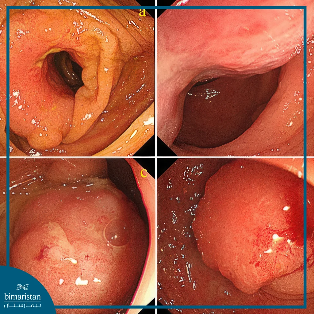Colonoscopy In Turkey: Procedure, Benefits, And Preparation Guide 5 Colonoscopy Images Show The Stages Of Examining The Lining Of The Large Intestine To Detect Pathological Changes.