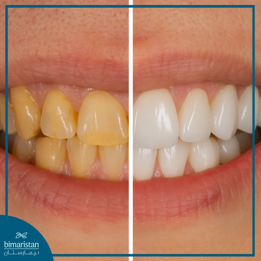 Efz Crowns: Combining Zirconium Strength &Amp; Emax Aesthetics 4 Before And After Efz Technique: A Radical Transformation That Merges Natural Beauty With Strength And Stability