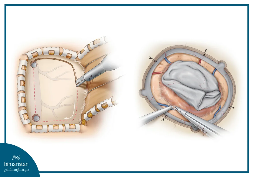 Meningioma Surgery: When It'S Needed And Chances Of Recovery 3 Meningioma Surgery (Craniotomy)