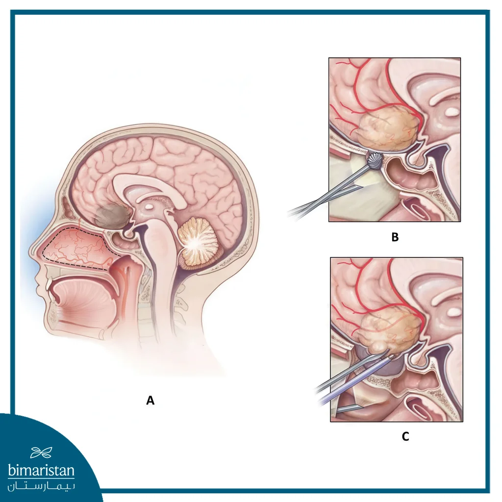 Meningioma Surgery: When It'S Needed And Chances Of Recovery 4 Endoscopic Neurosurgery For Meningiomas