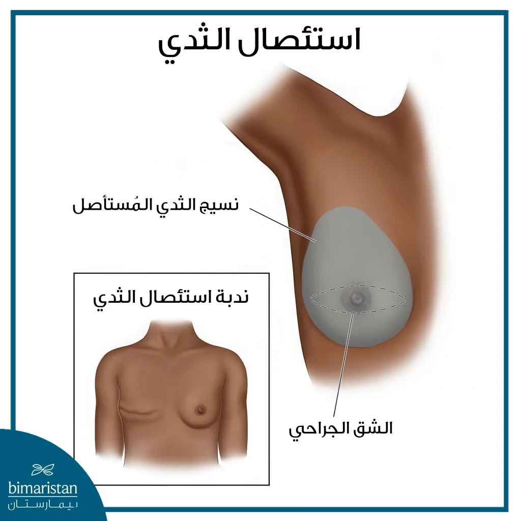 جراحة الثدي: ما بين التجميل والضرورة الطبية - كل ما تحتاجين معرفته 3 استئصال الثدي