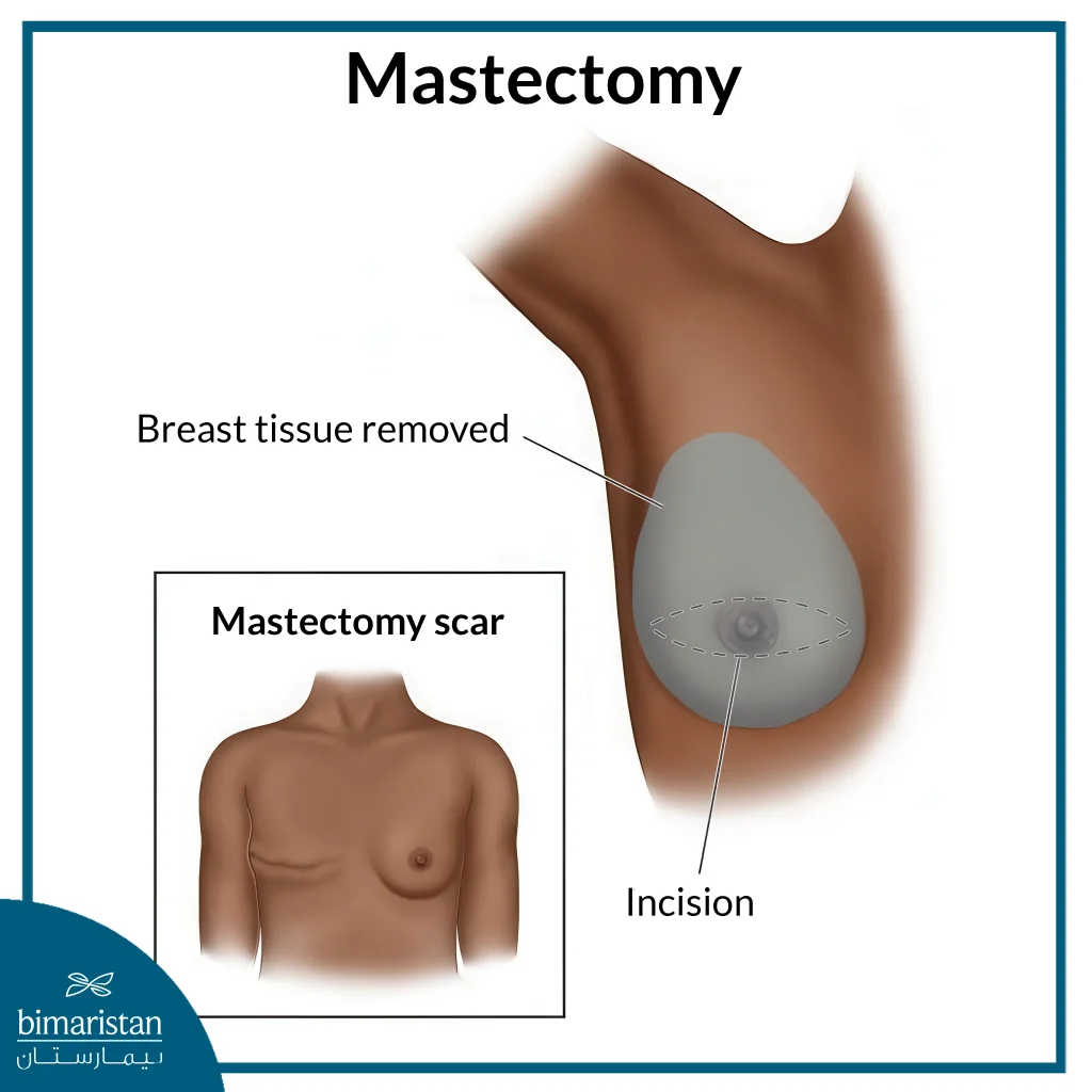 Breast Surgery: Procedures, Treatment &Amp; Recovery 3 Mastectomy