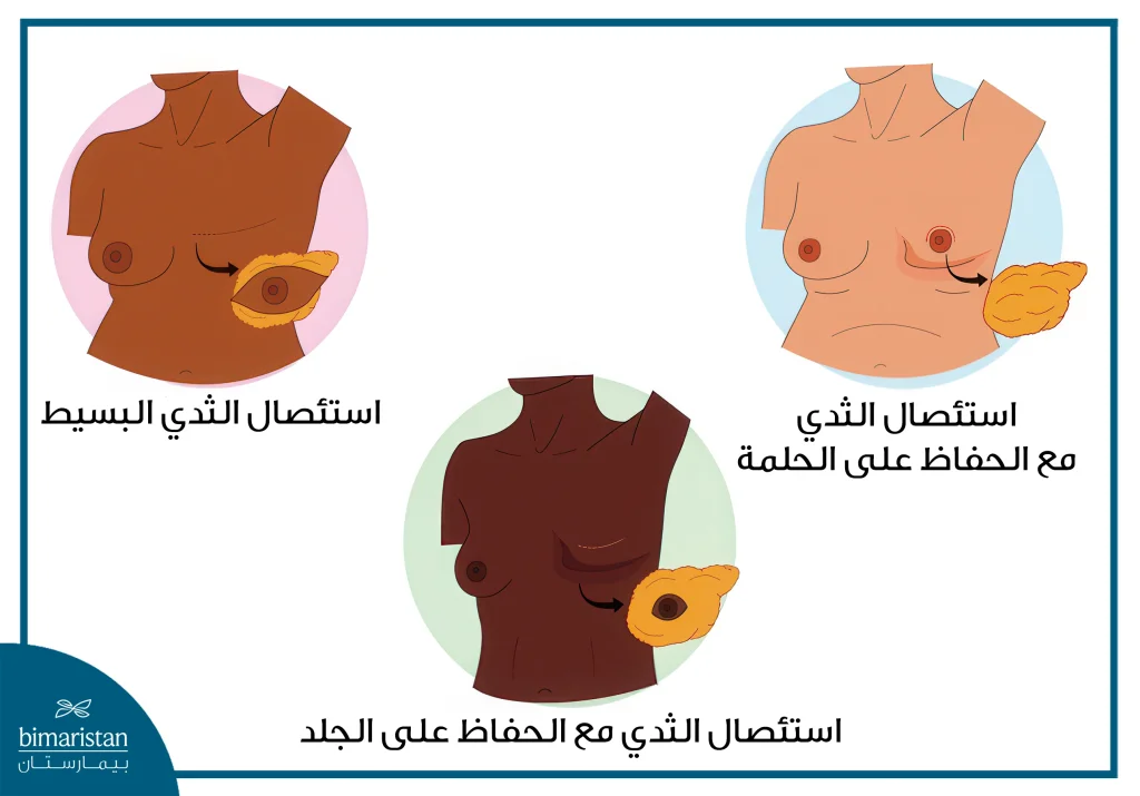 جراحة الثدي: ما بين التجميل والضرورة الطبية - كل ما تحتاجين معرفته 4 أنواع عملية استئصال الثدي