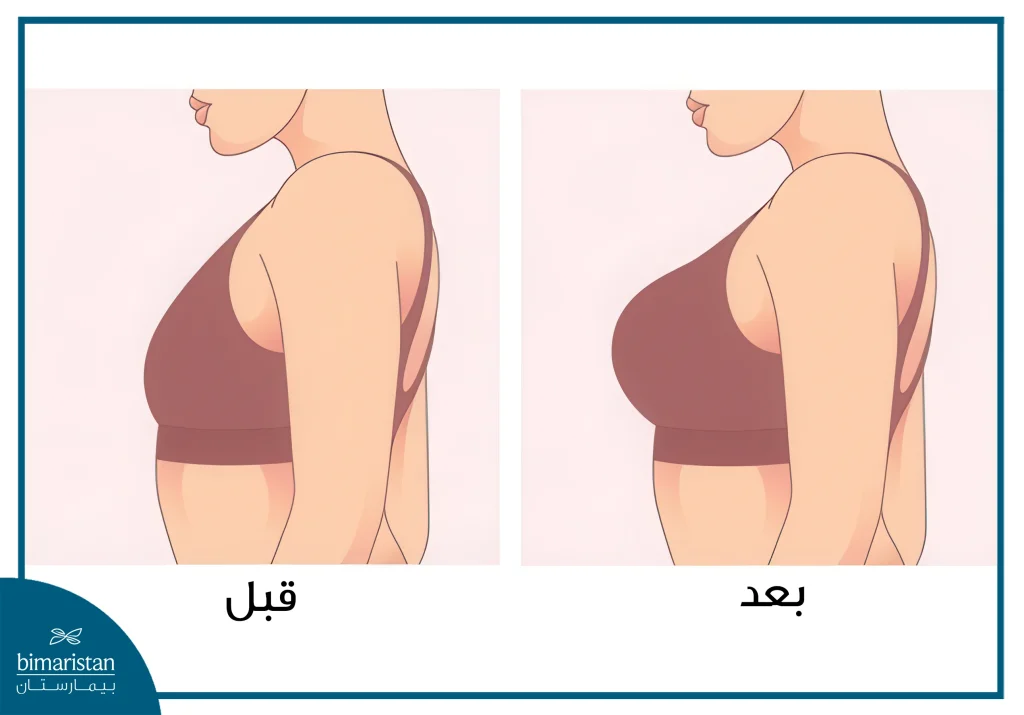 جراحة الثدي: ما بين التجميل والضرورة الطبية - كل ما تحتاجين معرفته 5 جراحة تكبير الثدي