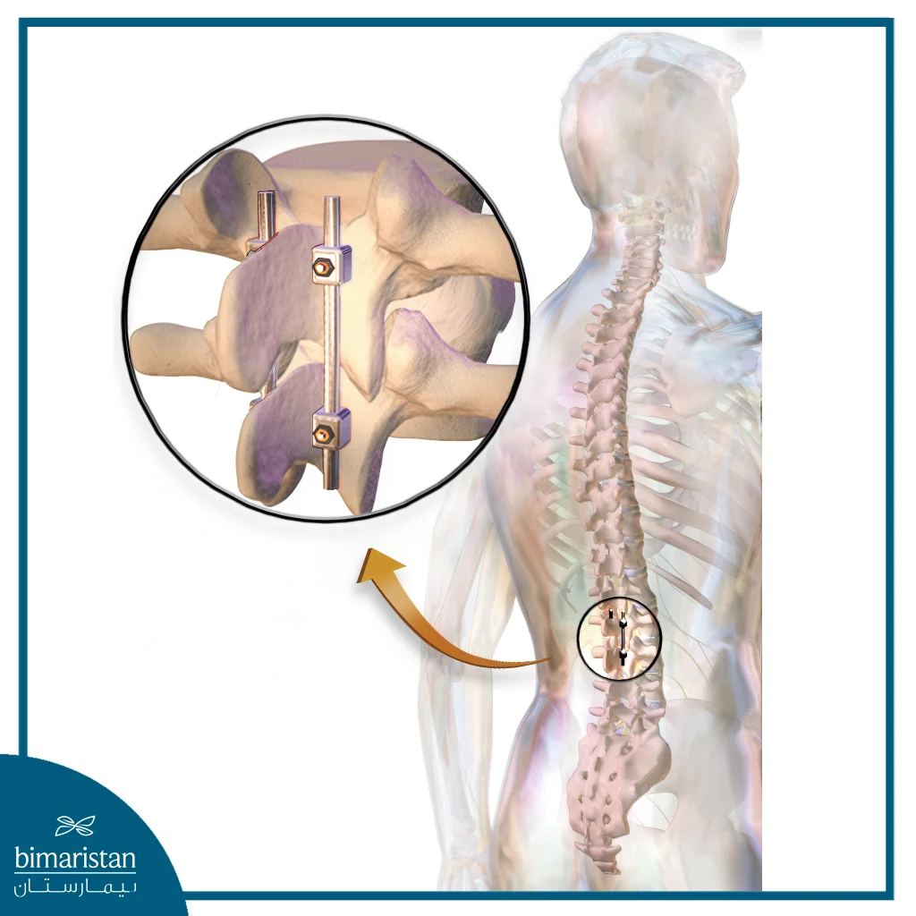 Scoliosis Surgery: Journey From Diagnosis To Full Recovery 5 Image Showing Scoliosis Surgery Using Rods And Nails