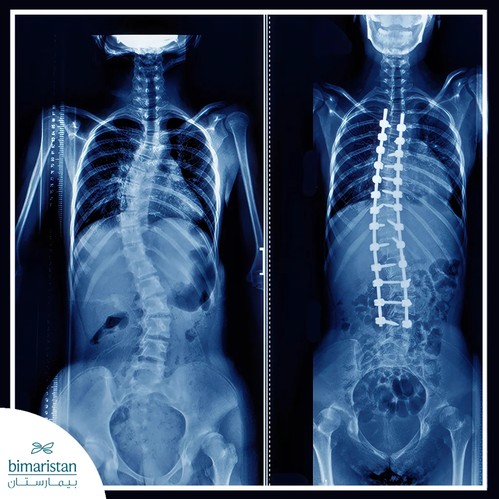 Scoliosis Surgery: Journey From Diagnosis To Full Recovery 4 Image Showing Spinal Fusion Surgery