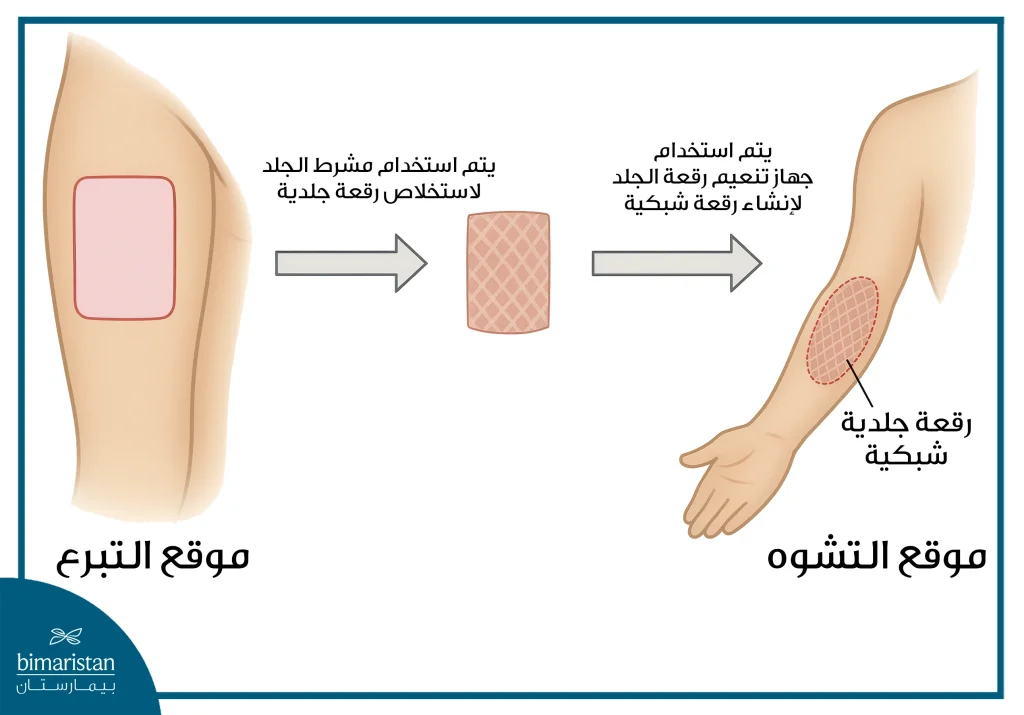 جراحة الحروق: الخطوات نحو الشفاء والتعافي الكامل 3 زراعة الجلد