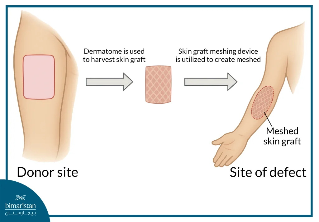 Burn Surgery: Steps Towards Healing And Full Recovery 3 Skin Grafting