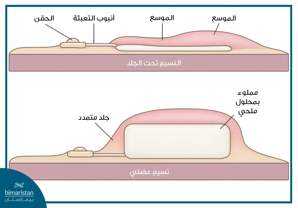 جراحة الحروق: الخطوات نحو الشفاء والتعافي الكامل 4 جراحة الحروق عن طريق توسيع الأنسجة