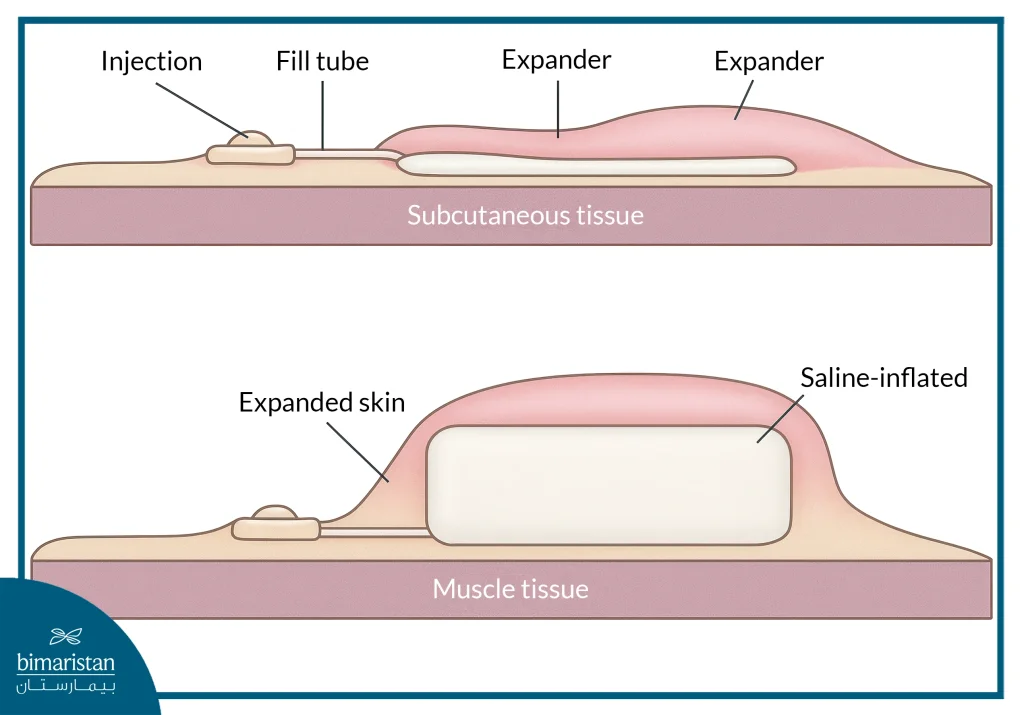 Burn Surgery: Steps Towards Healing And Full Recovery 4 Burn Surgery Using Tissue Expansion