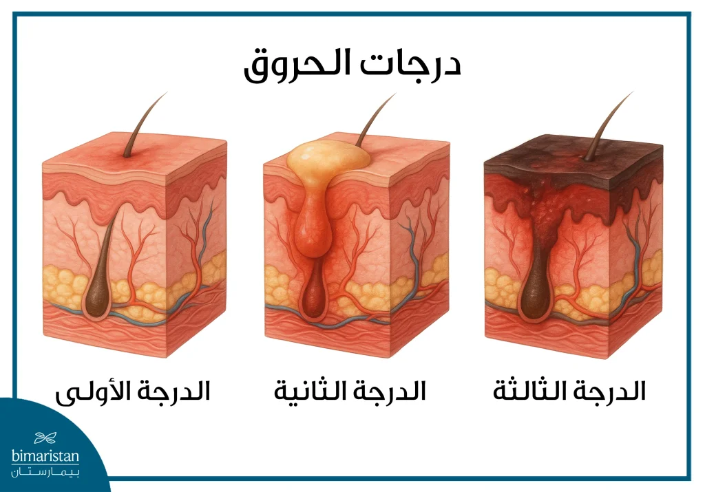جراحة الحروق: الخطوات نحو الشفاء والتعافي الكامل 2 درجات الحروق