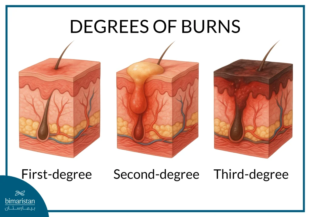Burn Surgery: Steps Towards Healing And Full Recovery 2 Degrees Of Burns