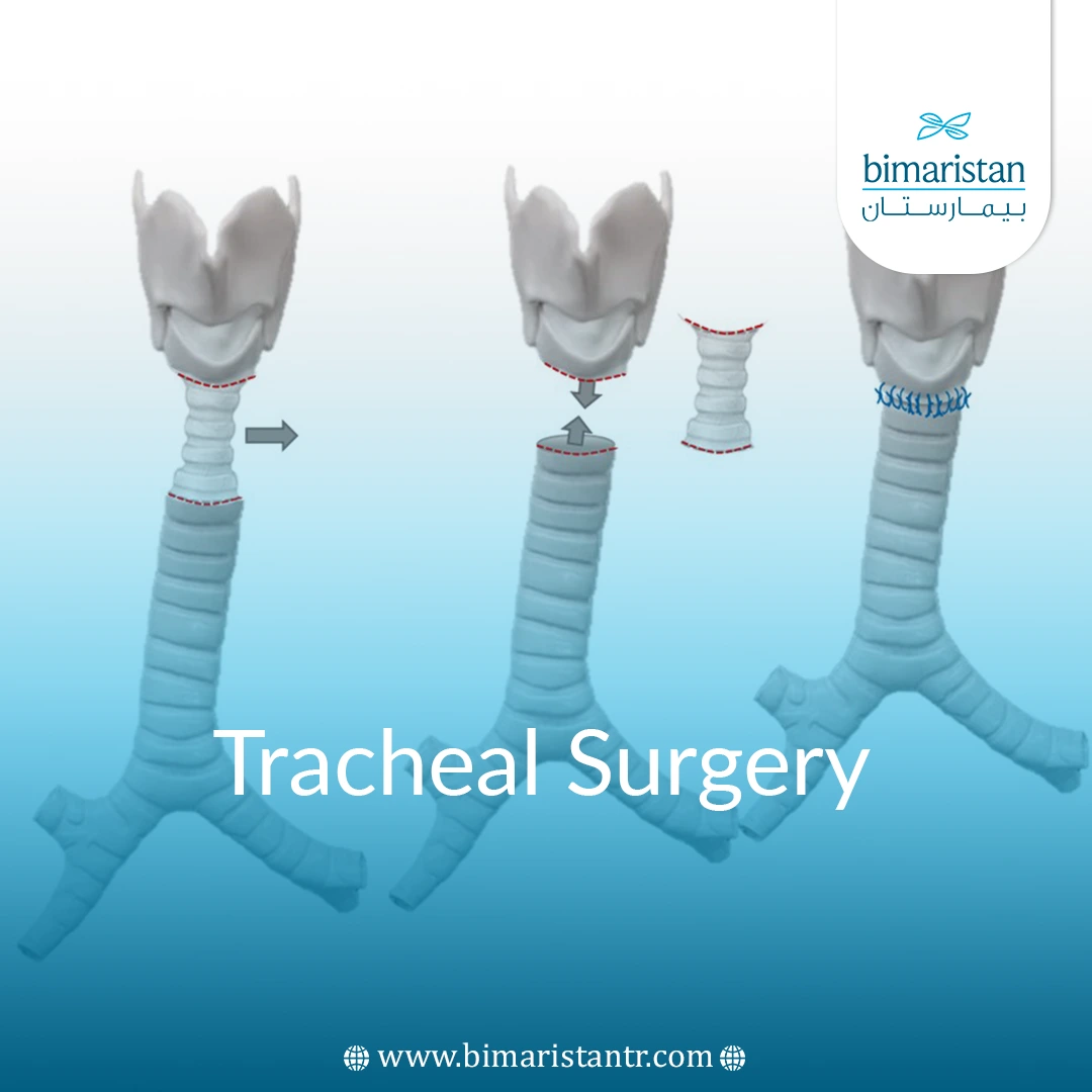 Tracheal Surgery In Turkey: Procedures, Risks &Amp;Amp; Recovery