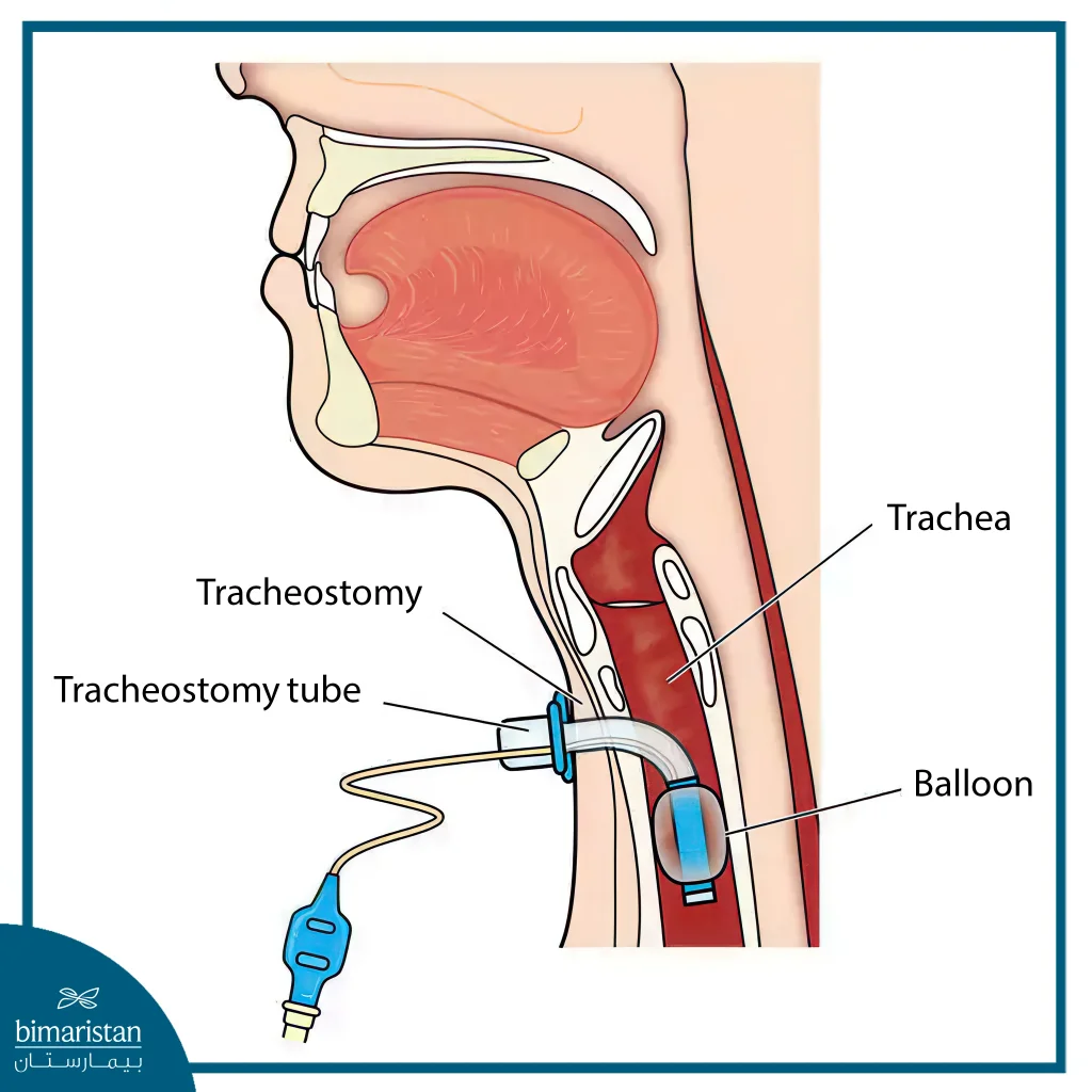 Tracheal Surgery: Windpipe Procedures, Risks &Amp; Recovery Guide 3 Tracheostomy Is A Type Of Tracheal Surgery That Has Multiple Benefits.
