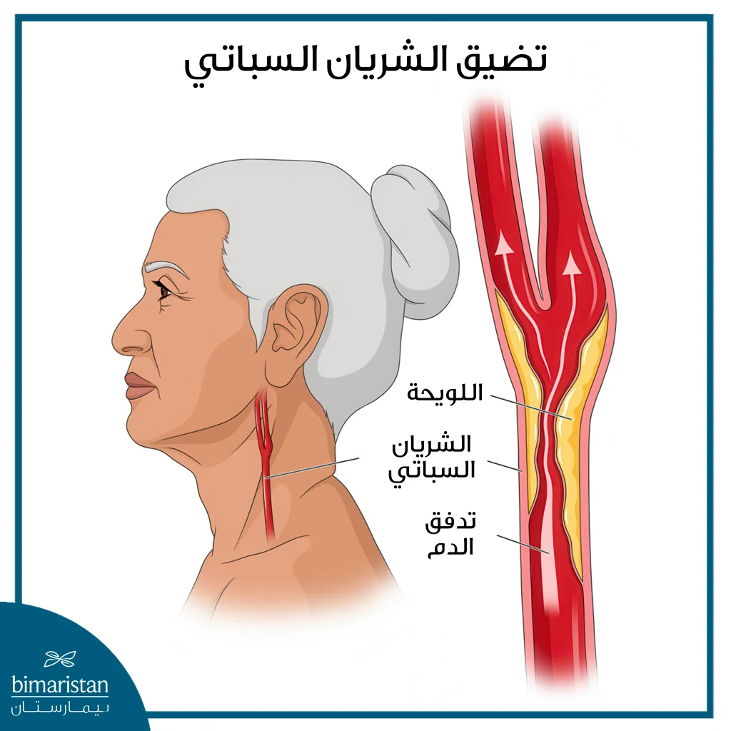 جراحة الشريان السباتي: متى تنقذك من السكتة الدماغية؟ 4 صورة توضح تضيق الشريان السباتي