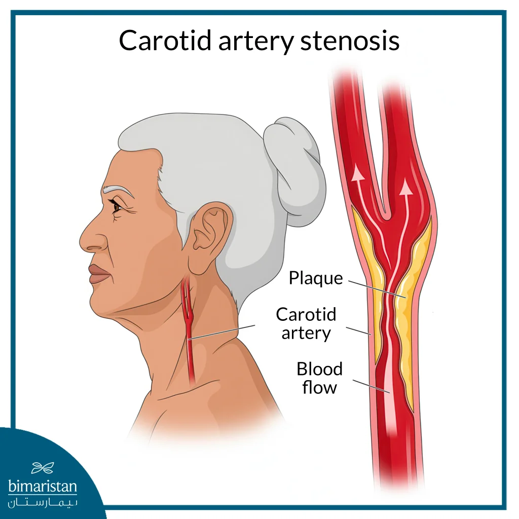 Carotid Artery Stenosis