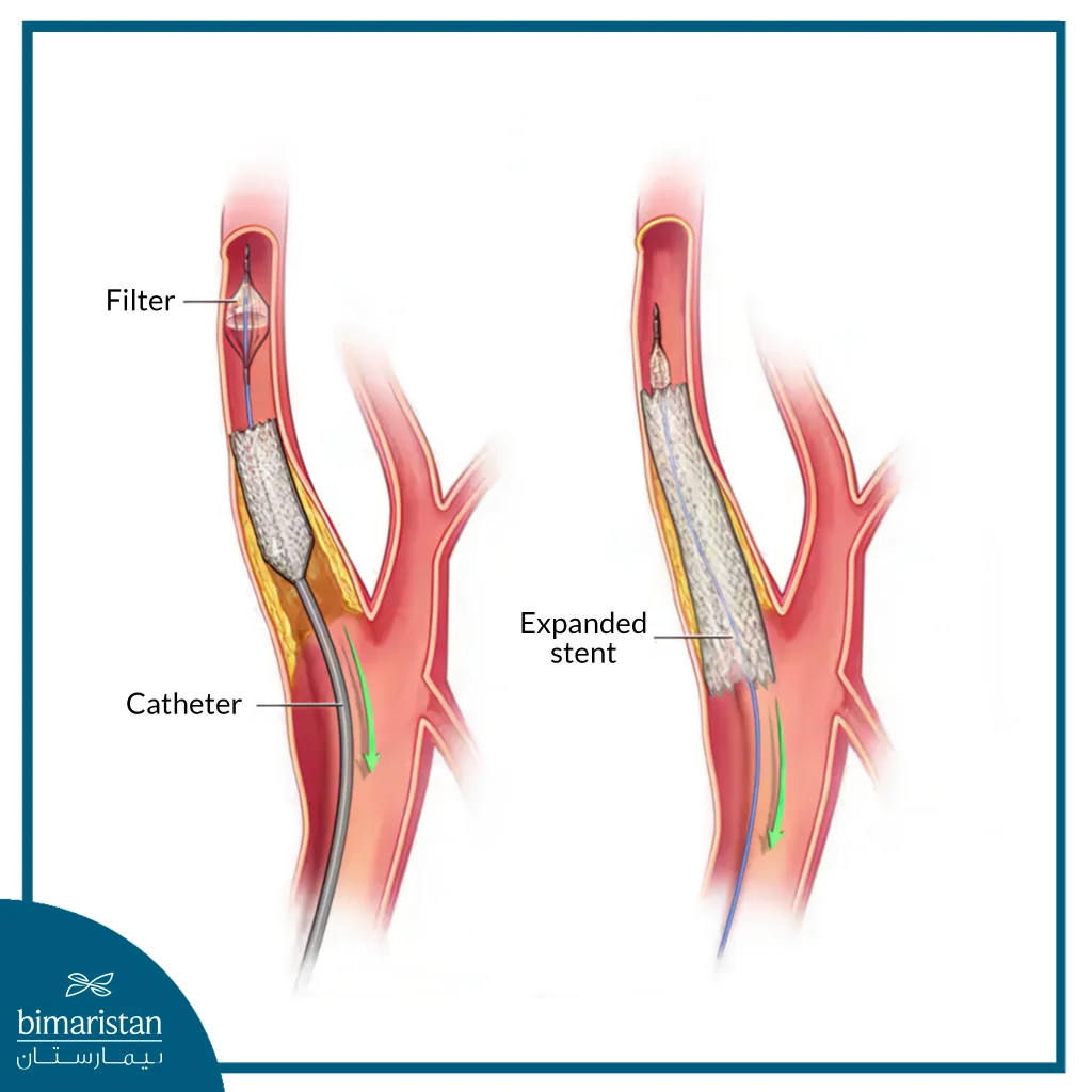 Illustration Of A Carotid Artery Surgery Using A Dilator Stent Procedure