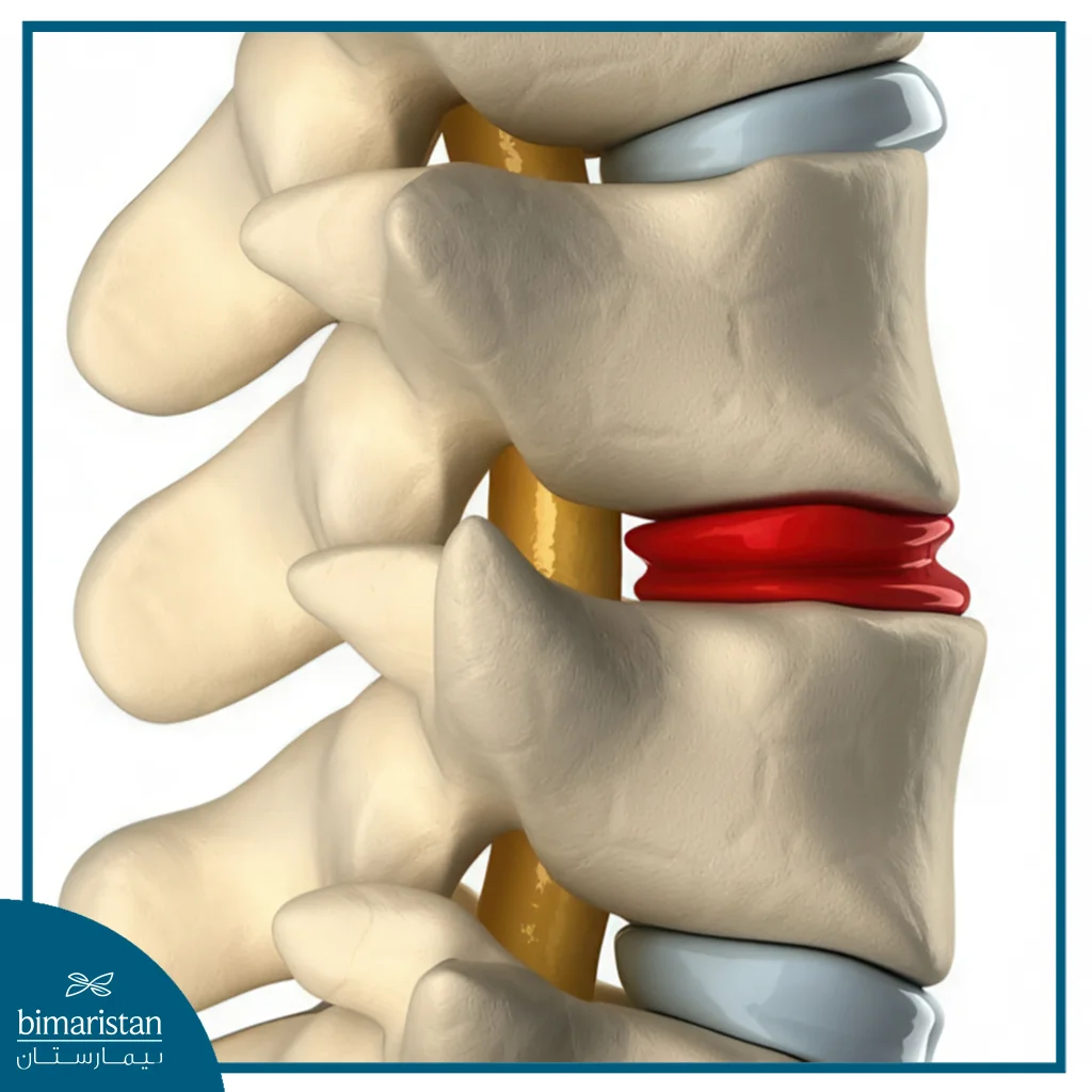 Artificial Disc Replacement: A Modern Alternative To Spinal Fusion For Herniated Discs 3 Artificial Disc Replacement Is A Surgical Intervention Aimed At Improving Spinal Mechanics And Patient Independence.