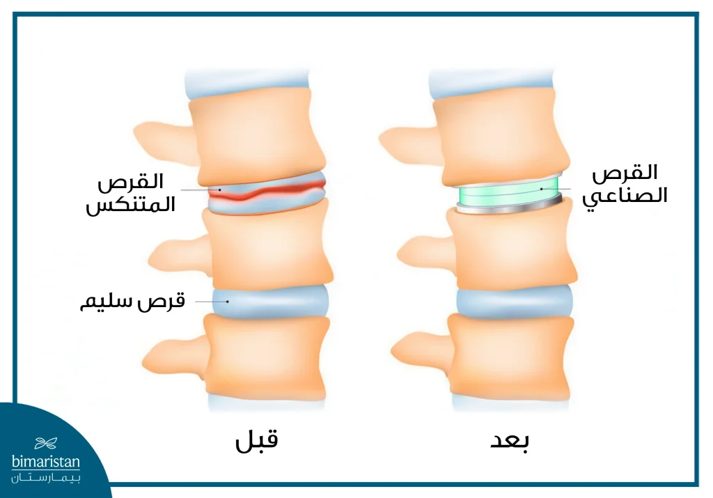 جراحة القرص الصناعي لعلاج انزلاق الغضروفي: بديل حديث لدمج الفقرات 3 تحول مثير في بنية العمود الفقري بعد إزالة الانزلاق لغضروفي
