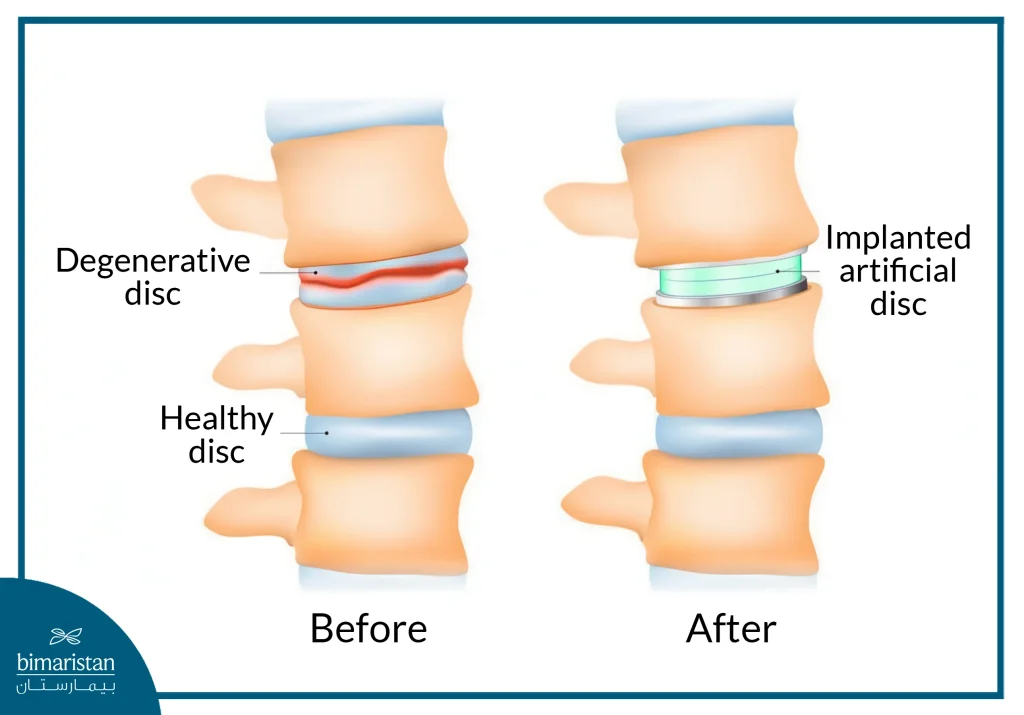 Artificial Disc Replacement: A Modern Alternative To Spinal Fusion For Herniated Discs 4 Dramatic Transformation Of Spinal Structure After Herniated Disc Removal