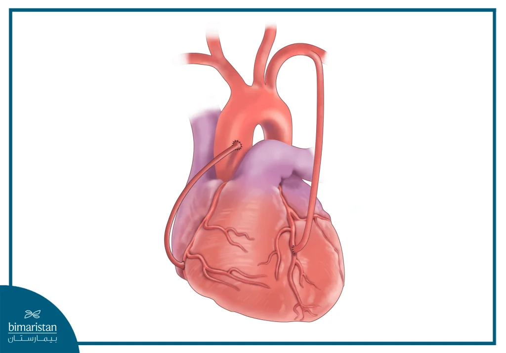 Coronary Bypass Surgery: Procedure, Recovery, And Benefits 4 The Normal Location Of The Heart And Coronary Arteries