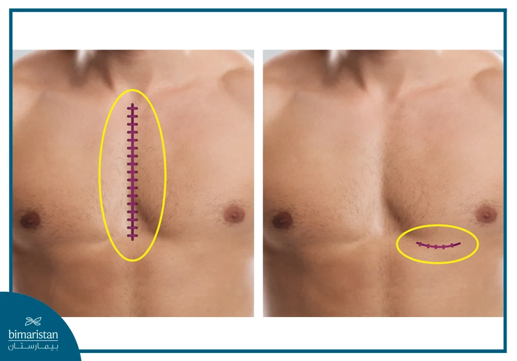 Coronary Bypass Surgery: Procedure, Recovery, And Benefits 5 Images Showing The Difference Between A Traditional Chest Bypass Scar And A Minimally Invasive Coronary Bypass Graft.