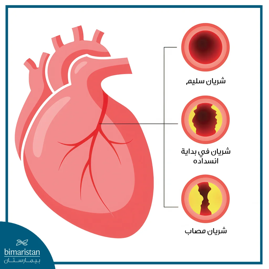 جراحة تحويل مسار الشريان التاجي 3 رسم توضيحي لمرض الشريان التاجي وكيف يظهر الشريان المصاب بالمقارنة مع الشريان السليم