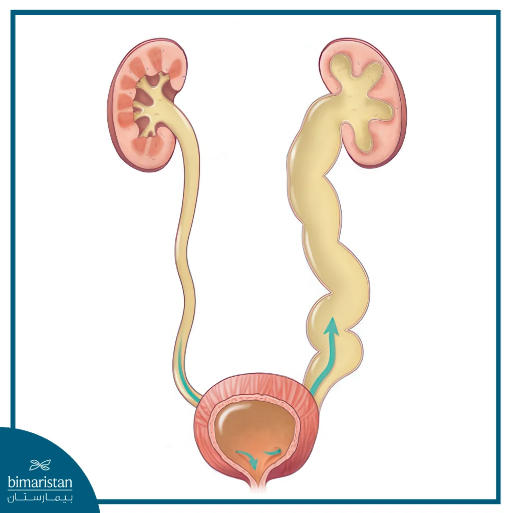 Surgery For Vesicoureteral Reflux: An Effective Solution For Reflux Issues 2 Vesicoureteral Reflux