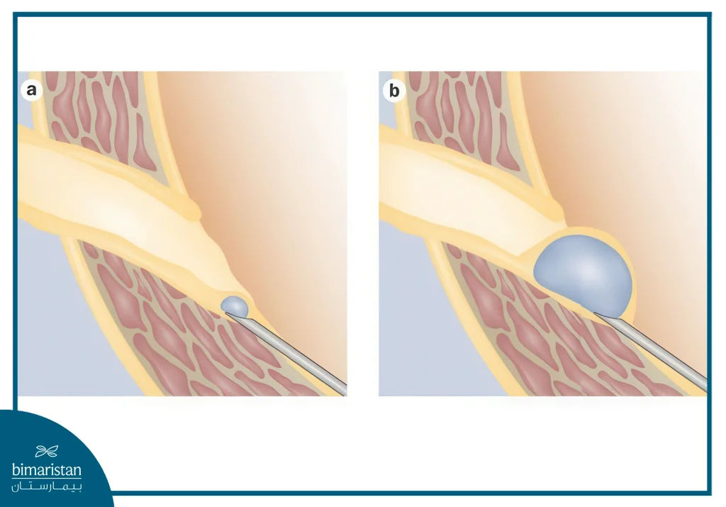 Surgery For Vesicoureteral Reflux: An Effective Solution For Reflux Issues 4 Surgery For Vesicoureteral Reflux Through Endoscopic Injection
