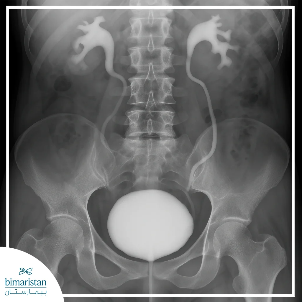 Surgery For Vesicoureteral Reflux: An Effective Solution For Reflux Issues 3 Voiding Cystourethrogram (Vcug)