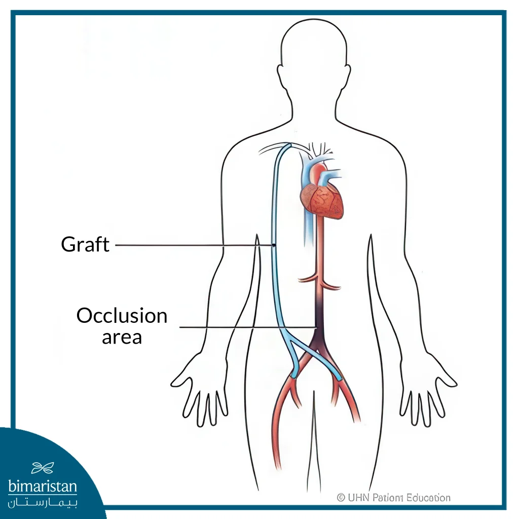 Aortic Bypass Surgery: Procedure, Benefits, And Recovery Guide 3 Axillary Femoral Bypass Is A Vascular Graft That Connects The Axillary Artery And The Femoral Artery To Bypass The Area Of Blockage.