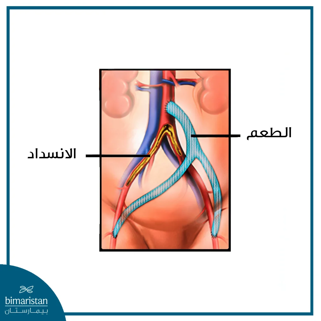 جراحة مجازة الشريان الأبهر 4 يتم في جراحة مجازة الشريان الأبهر زرع طعم يتجاوز منطقة الانسداد