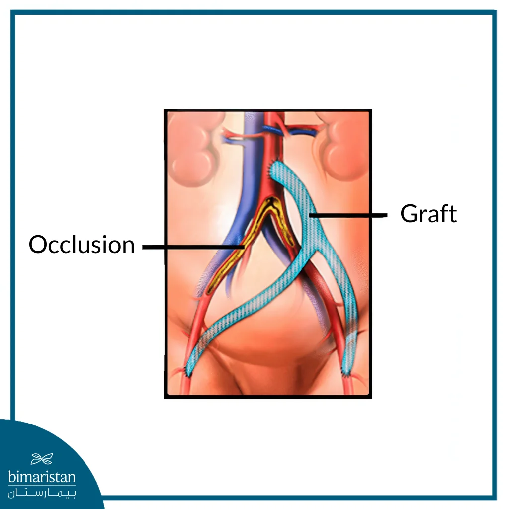 Aortic Bypass Surgery: Procedure, Benefits, And Recovery Guide 4 In Aortic Bypass Surgery, A Graft Is Implanted That Bypasses The Area Of Blockage.