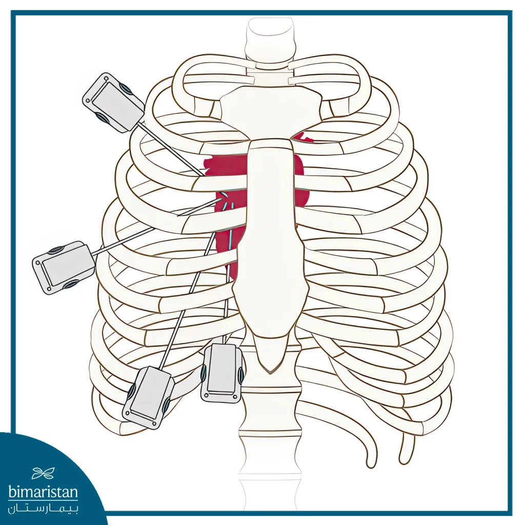 Minimally Invasive Direct Coronary Artery Bypass (Midcab) In Turkey 3 Image Showing Minimally Invasive Direct Coronary Artery Bypass