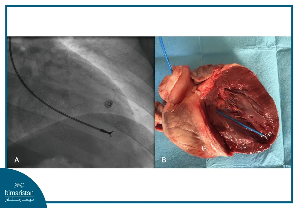 Cardiac Catheterization For Myocardial Biopsy: Technique, Risks &Amp; Benefits 3 A Cardiac Catheterization For Myocardial Biopsy Was Performed To Take A Heart Biopsy.