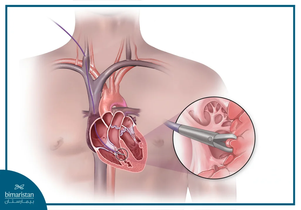 Cardiac Catheterization For Myocardial Biopsy: Technique, Risks &Amp; Benefits 4 Cardiac Catheterization For Myocardial Biopsy: Right Heart Catheter Inserted Through The Right Internal Jugular Vein.