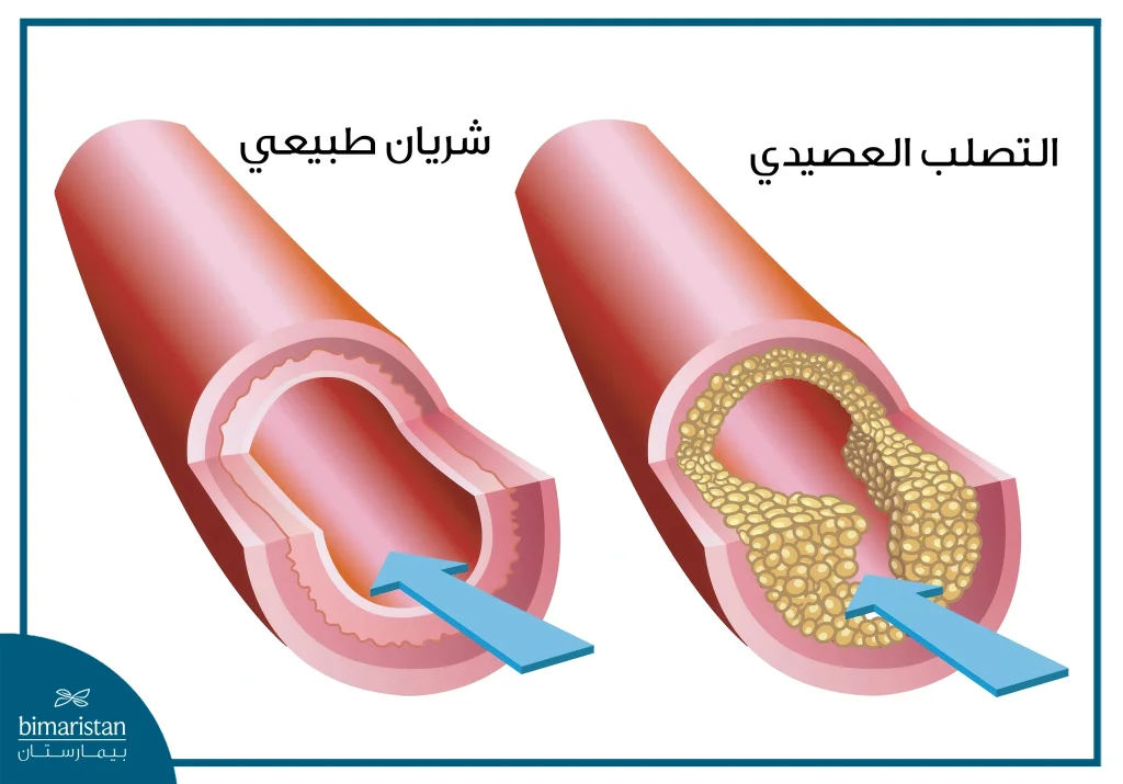 عملية تركيب دعامة القلب في تركيا 3 توضح هذه الصورة حالة التصلب العصيدي التي تتظاهر بتضيق الشريان نتيجة تراكم اللويحات الدهنية حول جدار الوعاء مما يستدعي تركيب دعامة القلب لتوسيعه