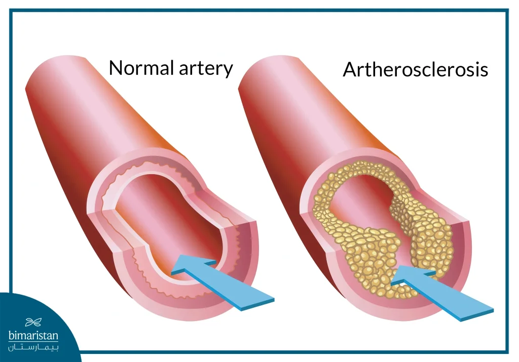 Coronary Stent Placement In Turkey: Procedure &Amp; Cost Guide 3 This Image Shows A Case Of Atherosclerosis, Which Is Manifested By Narrowing Of The Artery Due To The Accumulation Of Fatty Plaques Around The Vessel Wall, Which Requires The Placement Of A Coronary Stent To Widen It.