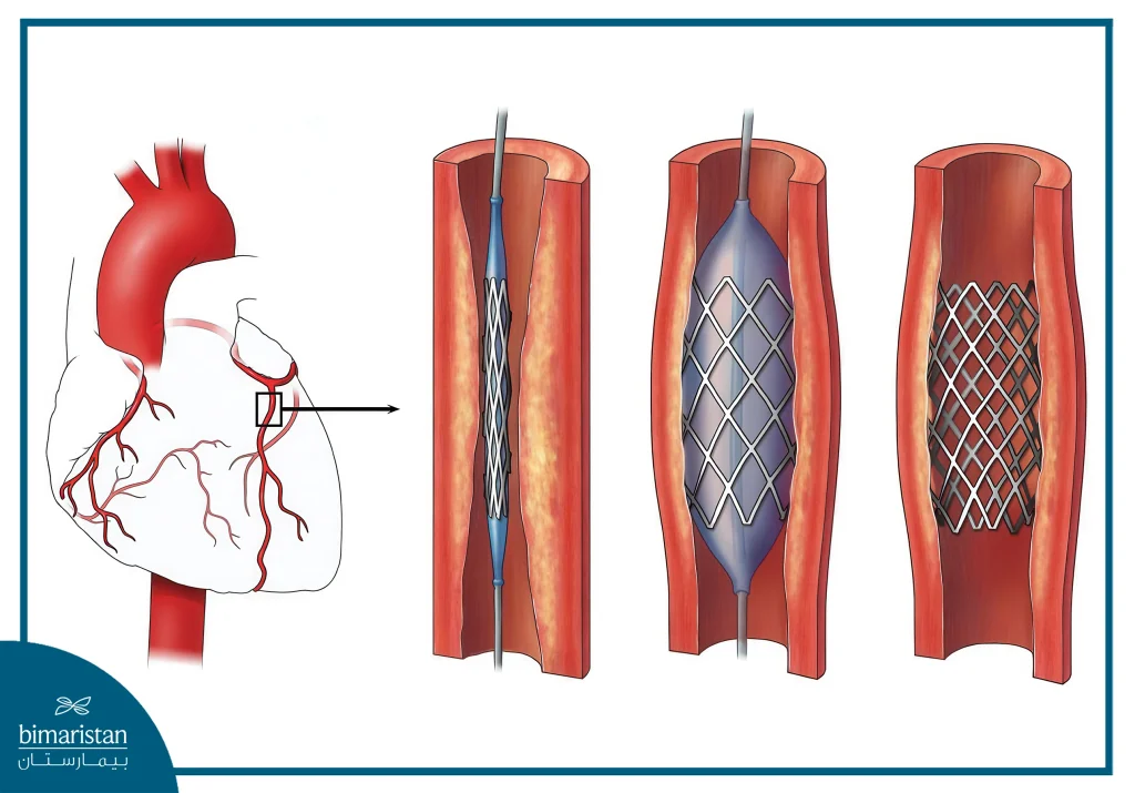Coronary Stent Placement In Turkey: Procedure &Amp; Cost Guide 5 Shape Of A Coronary Stent That Was Placed To Widen A Narrowed Artery
