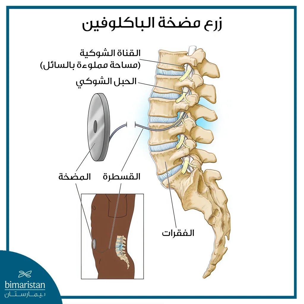 زرع مضخة الباكلوفين: الحل الفعال للتخلص من التشنجات 3 زرع مضخة الباكلوفين