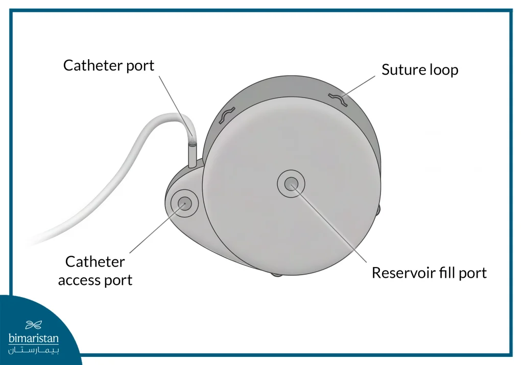 Baclofen Pump Implantation: An Effective Solution For Spasms And Pain 3 Baclofen Pump Shape And Parts