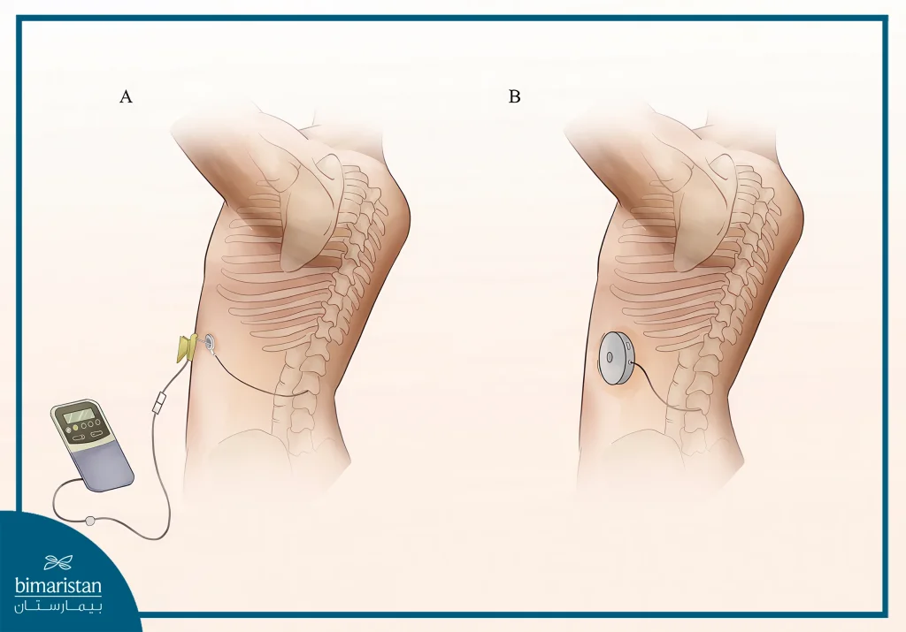 Baclofen Pump Implantation: An Effective Solution For Spasms And Pain 5 Trial Dose Testing Before The Baclofen Pump Is Permanently Implanted
