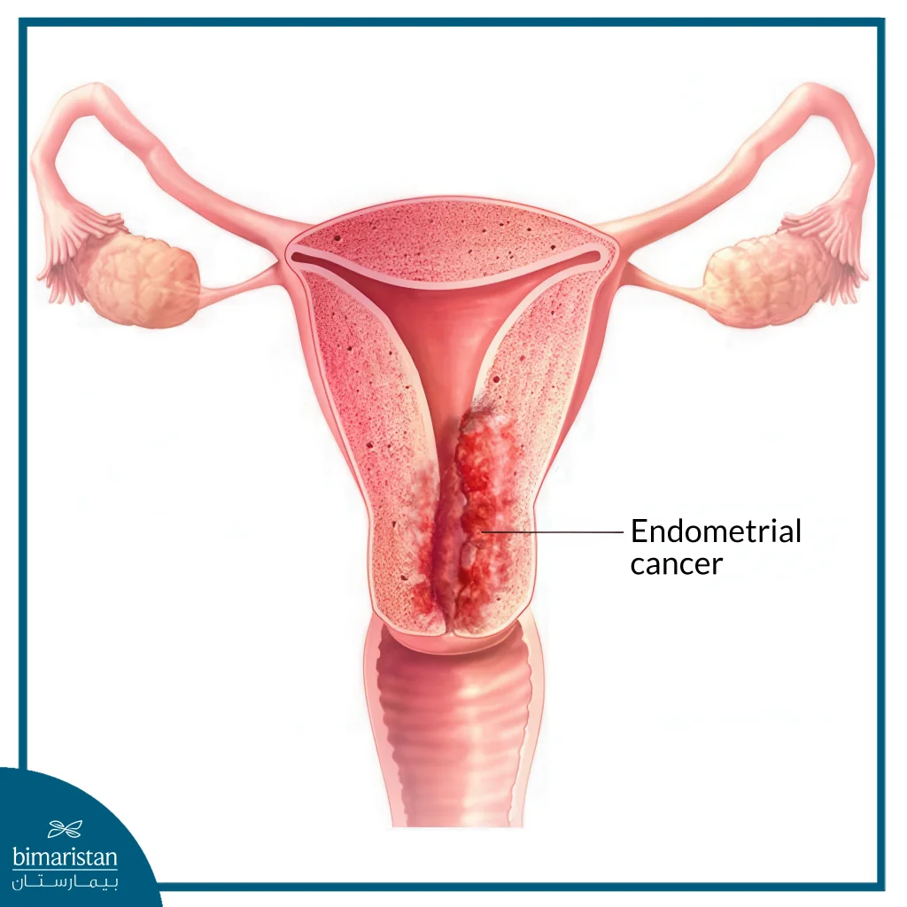 Uterine Cancer: A Comprehensive Guide For Women With Endometrial Cancer In Turkey 2 Illustrative Image Showing The Growth And Proliferation Of Cancer Cells In The Lining Of The Uterus.