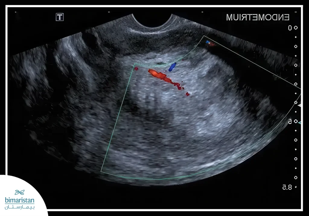 Uterine Cancer: A Comprehensive Guide For Women With Endometrial Cancer In Turkey 3 Ultrasound Image Showing Uterine Cancer