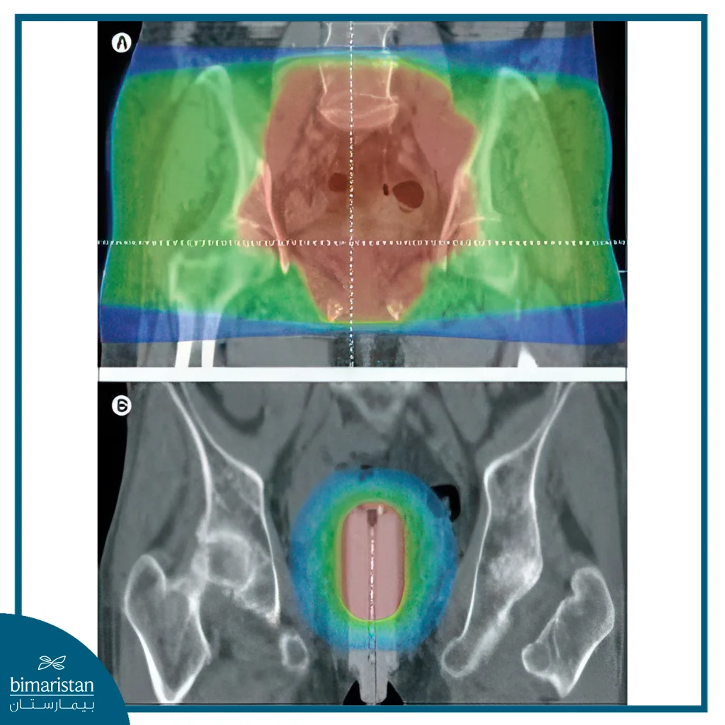 Uterine Cancer: A Comprehensive Guide For Women With Endometrial Cancer In Turkey 4 X-Ray Image Showing The Location Of The Radiation Focus For Treating Uterine Cancer